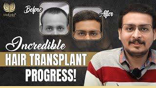 Hair Transformation at 3 Months | Incredible Hair Transplant Progress! | MedLinks