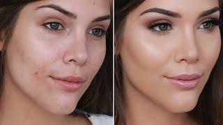 How to Cover Acne and Pimples With Makeup! | Katerina Williams