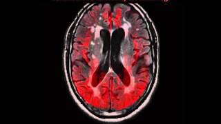 The Aging Brain: Week by Week Time Lapse