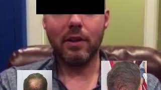 FUE Hair Transplant & Liposuction Testimonial - Harleys Clinic