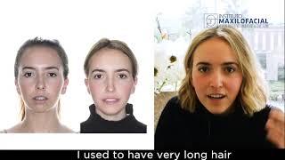 Double jaw surgery. Case # 76: Inés - Class 2, open bite, mandibular hypoplasia