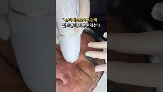 창원피부 슈퍼맥스 리프팅 하이푸, 70대도 가능한 강력 리프팅의 비밀#난너를예쁘게해 #창원리프팅