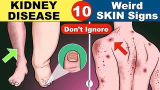 Skin signs of Kidney Disease | Chronic Kidney Disease | Kidney Failure Symptoms | CKD