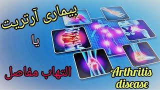 آرتریت:دلایل ابتلا به آرتریت عوامل موثر بر آن!!؟؟