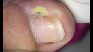 Super infected nail