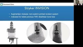 A Comparative Analysis of Outcomes in Total Ankle Replacement