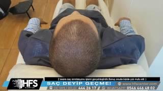 Saç simülasyonu nedir ? Nasıl yapılır ?