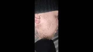 minoxidil 2022 before & after