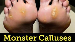 SHAVING OF GINORMOUS PAINFUL PLANTAR CALLUSES AND CORNS