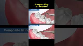 Amalgam filling vs composite #dentist #dentisty #filling