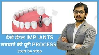 Exact procedure of dental implants.. Step by Step explained