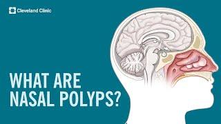 What Are Nasal Polyps?