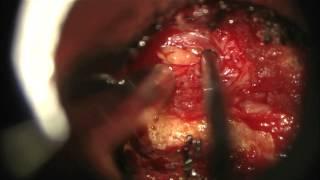 Minimally invasive surgery for lumbar microdiscectomy