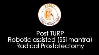 Post TURP Robotic assisted (SSi mantra) Radical Prostatectomy