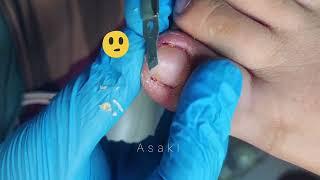 Cut Dirty Ingrown Toenail 剪大脏向内生长脚趾甲 #shorts #video #health