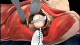 Femoral Head Osteotomy Animation - Direct Anterior Total Hip Replacement