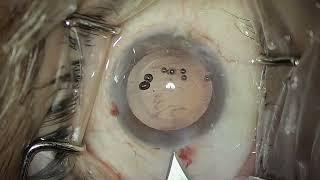 Loading and Implantation of multipiece IOL