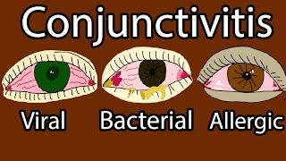 Pink Eye (Conjunctivitis) - Viral, Bacterial and allergic conjunctivitis. Symptoms and treatment