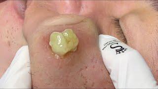 cystic acne blackhead whitehead removal | Relaxing Spa Acne Treatment