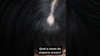 Qual a causa da alopecia areata #autoimmunedisease