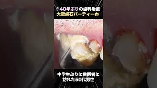 【40年溜めた歯石】中学生ぶりに歯科治療をした50代男性の歯石除去パーティー #歯医者 #ザホワイトデンタルクリニック #歯石除去