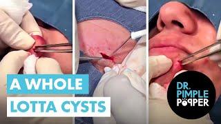 A Whole Lotta Cysts