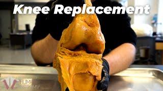 Is KNEE REPLACEMENT the MOST PAINFUL surgery ever?