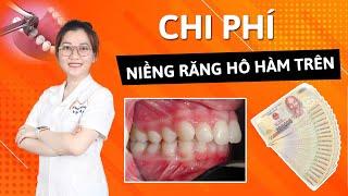 Chi phí Niềng răng HÔ hàm trên bao nhiêu tiền? Bảng Giá Mới Nhất 2021