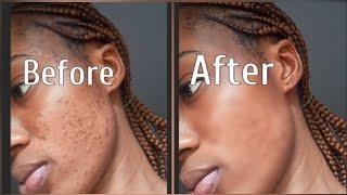 Skin Retouching. Remove Acne and Pimples using Photoshop