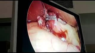 LIVE Laparoscopic surgery | Dr. Seraj Ahmed