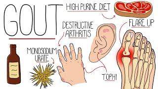 Understanding Gout (Gout Explained Clearly)