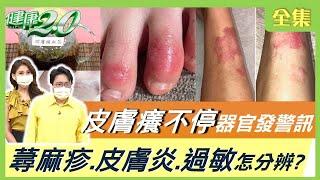 過敏起疹子 惱人皮膚癢 慢性皮膚炎 是器官生病了？！ 健康2.0 20210829 (完整版)