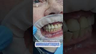 От сложного случая к красивой улыбке. From a difficult case to a beautiful smile.