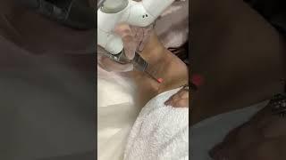 Q-Switched Laser - Underarm Lightening