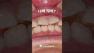 공간 부족으로 인한 #나비치아 교정과정 #치아교정