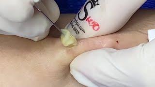 Satisfying Steatocystoma Popping