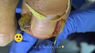 Cut Dirty Ingrown Toenail 剪大脏向内生长脚趾甲 #shorts #video #health