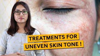 Treatments for Uneven Skin Tone! | Dr. Deepika Lunawat