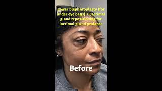 African American Lower Blepharoplasty-- Dr. Mehryar Taban-- CALL 310-299-8313