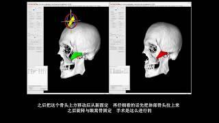 [H整形医院] 致准备颧骨手术(颧骨缩小术，颧骨内推手术)患者