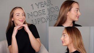 1 YEAR RHINOPLASTY UPDATE! | Regrets? Swelling, Pain, etc!