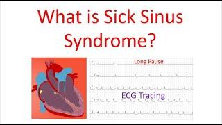 What is Sick Sinus Syndrome?