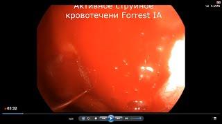 Endoscopic Treatment of Upper Gastrointestinal Ulcer Bleeding. Forrest IA/ Язвенное кровотечение