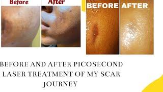 SOME BEFORE PICOSECOND LASER TREATMENT AND AFTER PICTURES OF MY SCAR JOURNEY AND SOME OTHERS