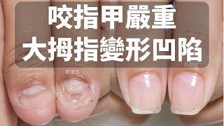 Serious biting nails - examples of male corrections in which the nails are deformed, the nail bed