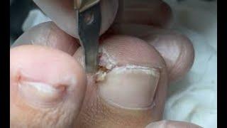 Pedicure tutorial: Big nail under toe corner, feel so much relief