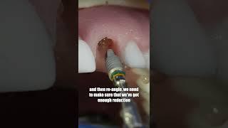 HOW TO: Immediate Implant - With Dr Lincoln Harris