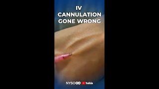 IV Cannulation gone wrong?