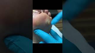 Doctor caught in the splash zone! #warts #pops #foot #healthyfeet #podiatry #podiatrist #feetcare