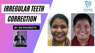 Dental braces for irregular teeth- by Dr.Praneeth Kumar